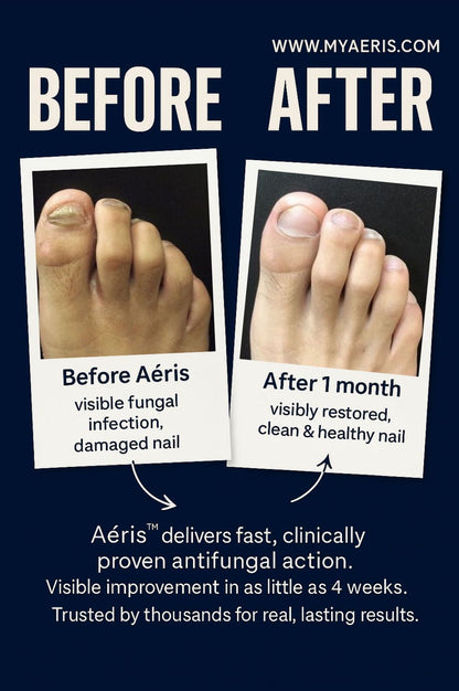Aéris™ Antifungal Pen – Fast Relief, Clean Formula